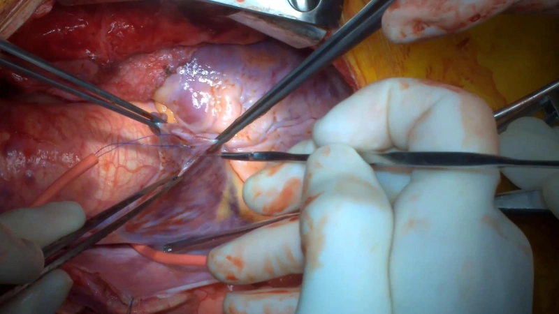 Cardiac and open surgery first-person recording with head-mounted surgical camera